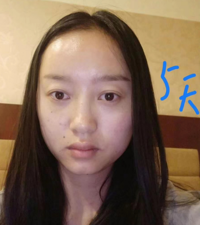 去眼袋手术