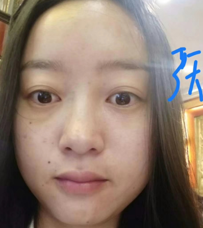 去眼袋手术