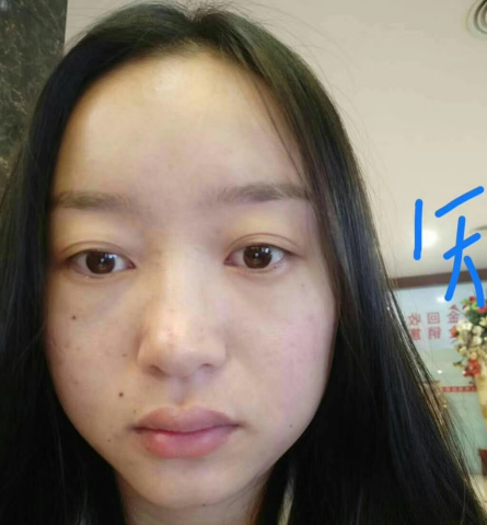 去眼袋手术