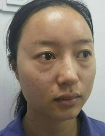 去眼袋手术