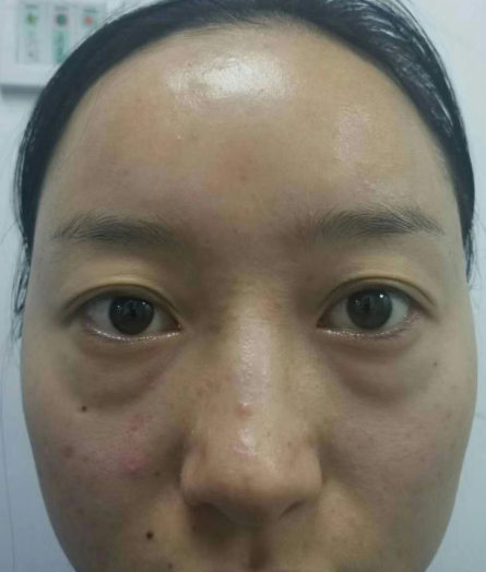 去眼袋手术