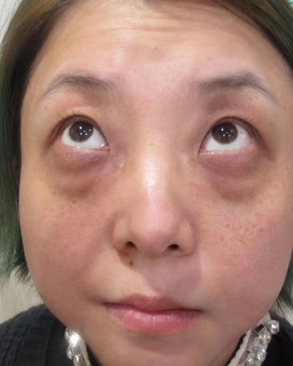 去眼袋手术