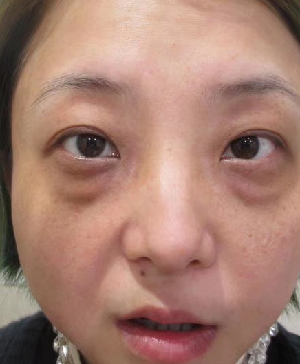 去眼袋手术