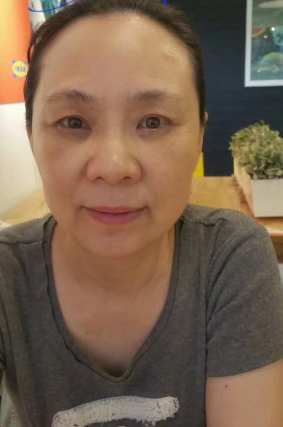 去眼袋手术