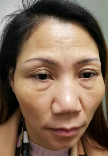 去眼袋手术