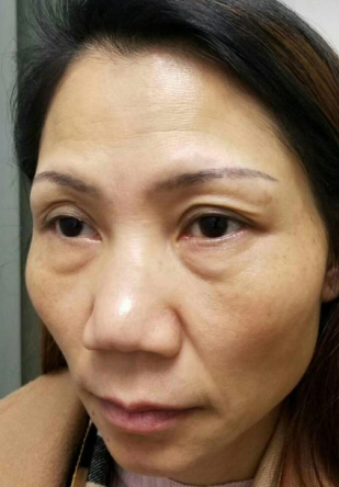 去眼袋手术