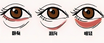 去眼袋手术