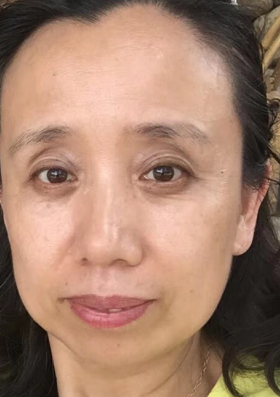 去眼袋手术