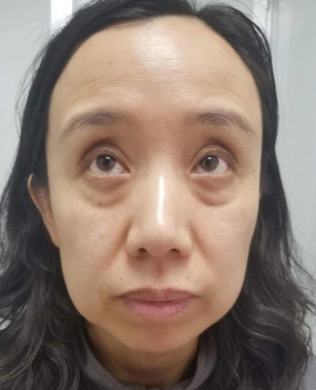 去眼袋手术