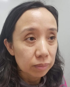 去眼袋手术
