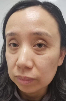 去眼袋手术