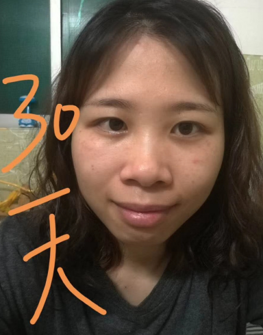 去眼袋手术