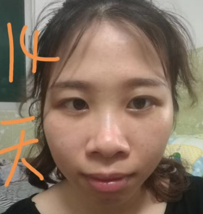 去眼袋手术