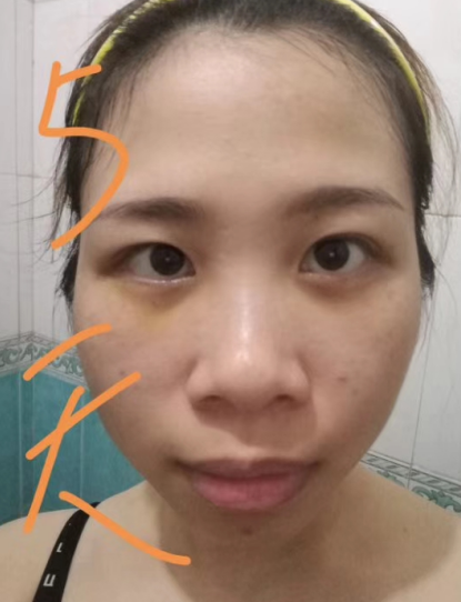 去眼袋手术