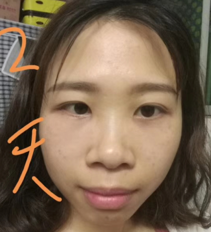 去眼袋手术