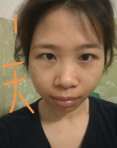 去眼袋手术