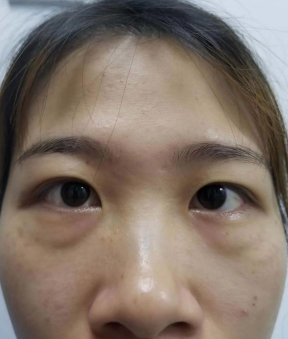 去眼袋手术