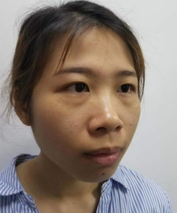 去眼袋手术
