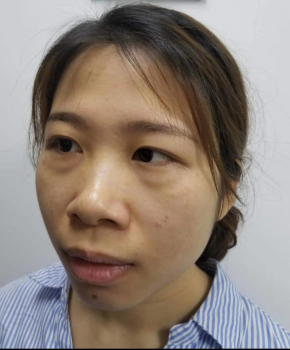 去眼袋手术