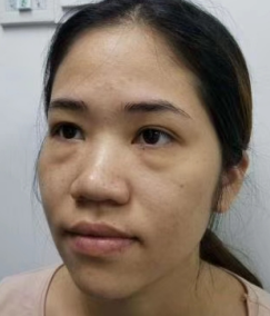 去眼袋手术