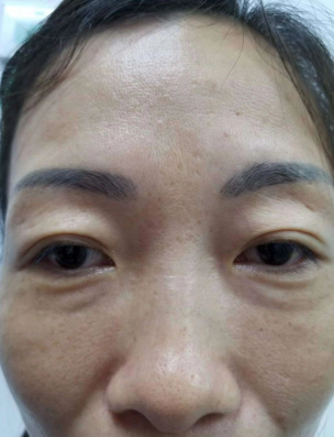 去眼袋手术