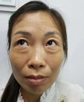 去眼袋手术