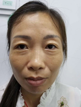 去眼袋手术