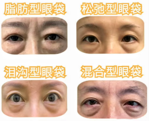去眼袋手术