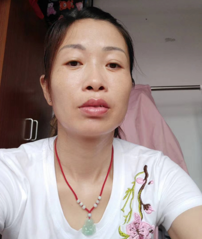 去眼袋手术