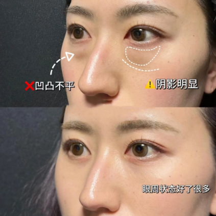 去眼袋手术