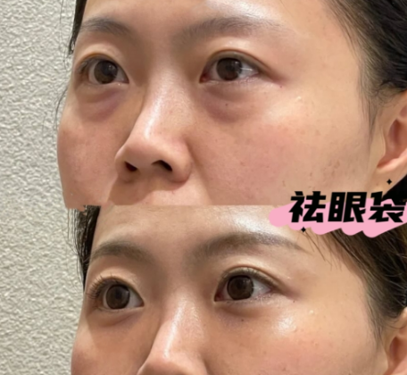 眼袋