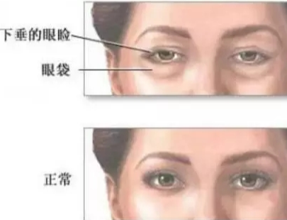 眼袋