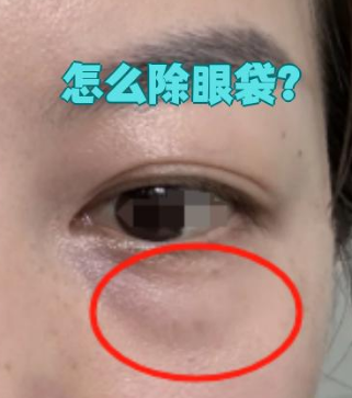 眼袋