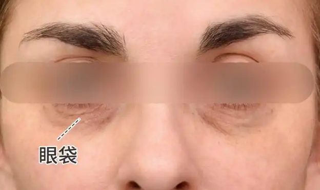 眼袋