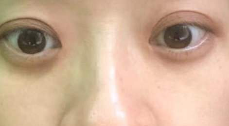 去眼袋手术