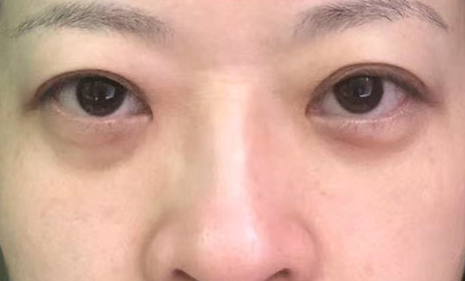 去眼袋手术