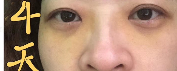 去眼袋手术