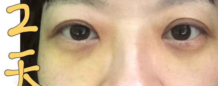 去眼袋手术