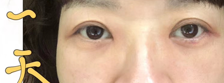 去眼袋手术