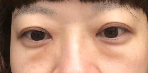 去眼袋手术