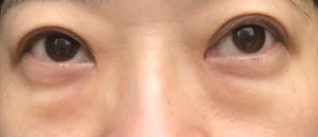 去眼袋手术