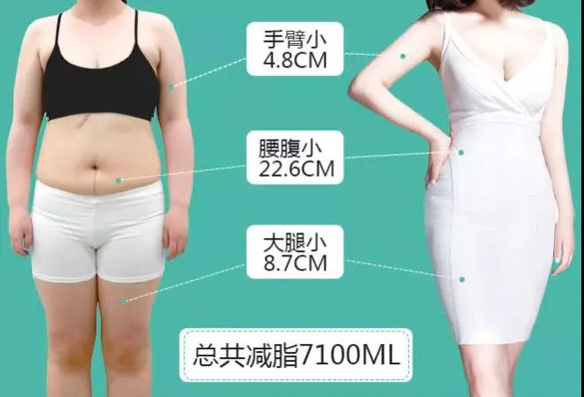 吸脂减肥
