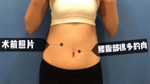 吸脂减肥