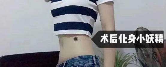 吸脂减肥