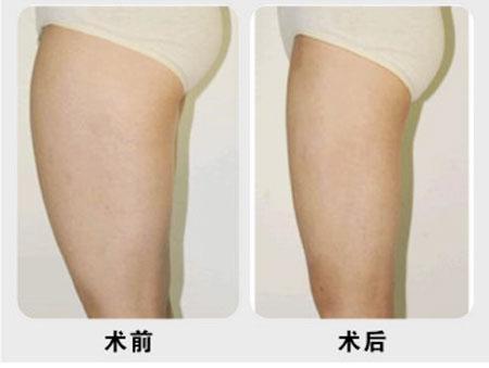 吸脂减肥：人间芭比Lisa在国内照妖镜下，真实颜286