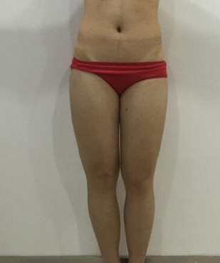 超声波减肥