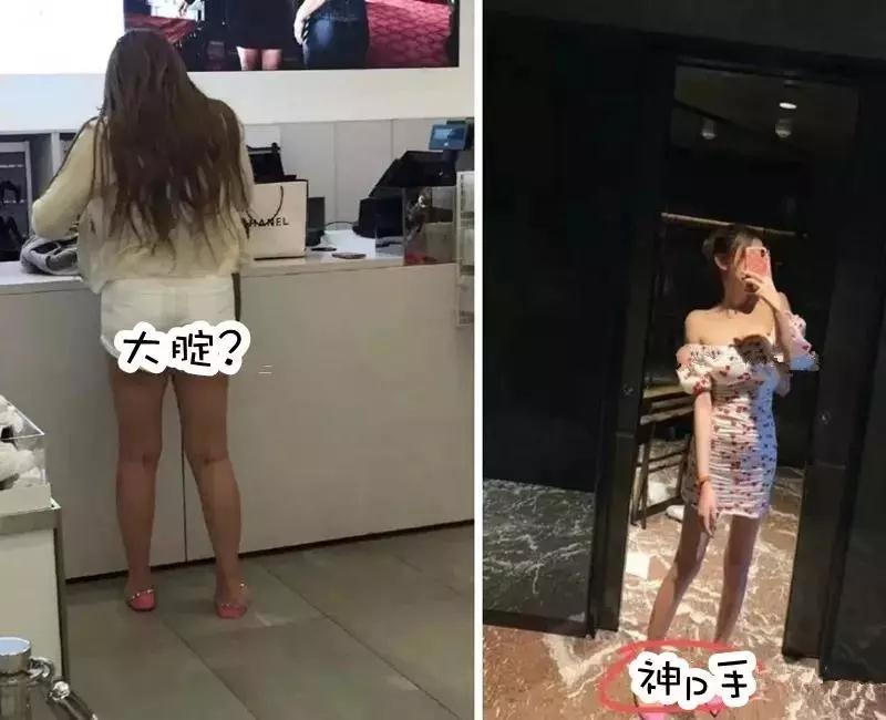 吸脂减肥