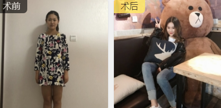 吸脂减肥