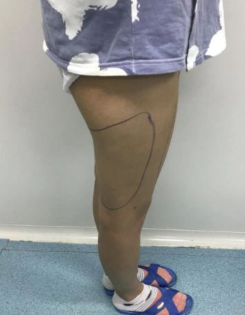 吸脂减肥