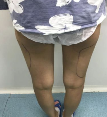 吸脂减肥